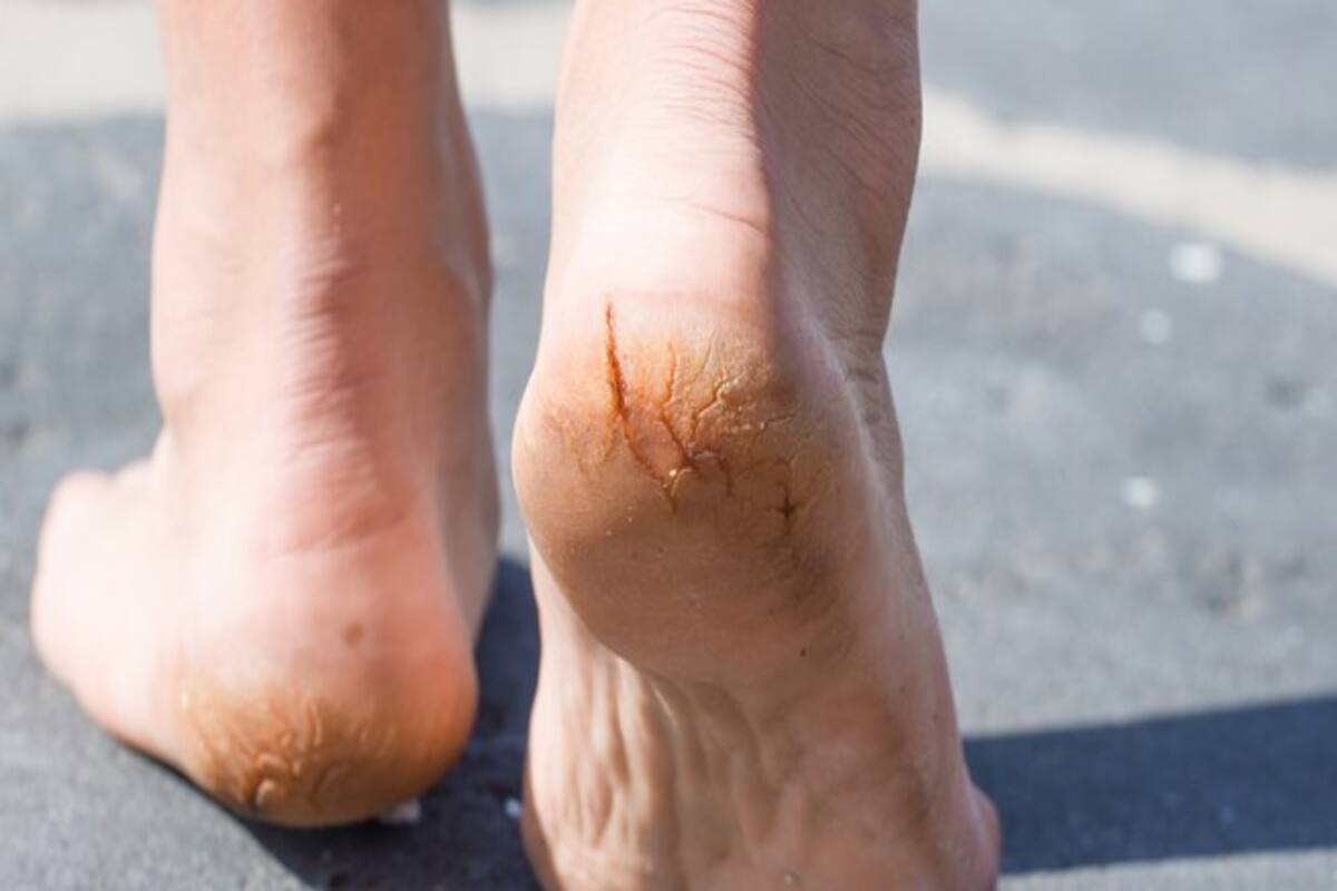 6 Reasons Your Feet Are Peeling Even In Summer Thehealthsite Com