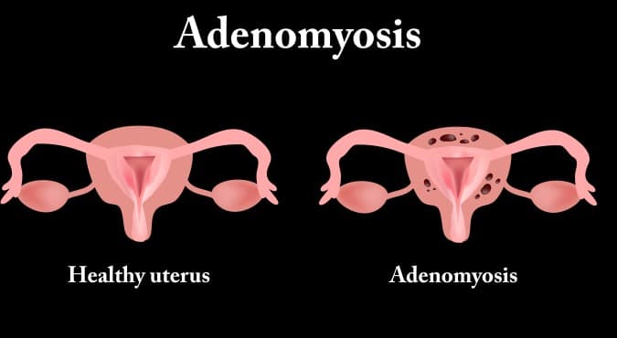 Bulky Uterus: Symptoms, Causes and Treatment