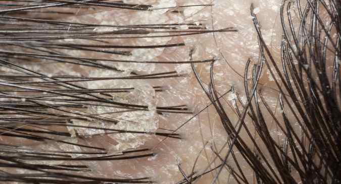 Here are 7 dandruff myths busted by an expert! - Read Health Related ...