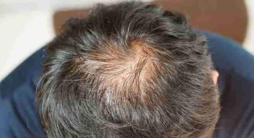 7 common causes of chronic itchy scalp | TheHealthSite.com