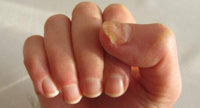 5 Common Causes Of Yellow Nails Read Health Related Blogs Yellow Nails