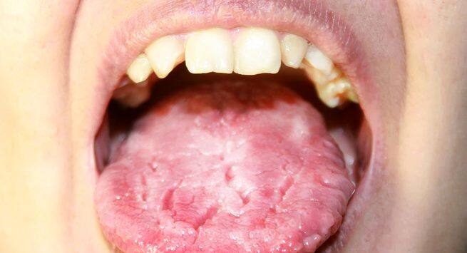 How To Get Rid Of White On Tongue