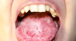 Home remedies to deal with white tongue