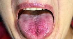 Did You Know Cigarette Smoking Can Cause Tongue Cancer? Signs To Watch Out For