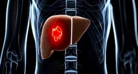New focused radiotherapy a boon for liver cancer patients