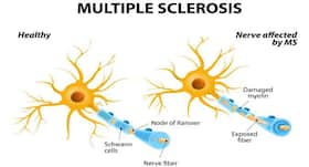 World Multiple Sclerosis Day 2018 - What is multiple sclerosis and what are its causes?