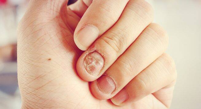 6 gross things that happen to you when you bite your nails! |  