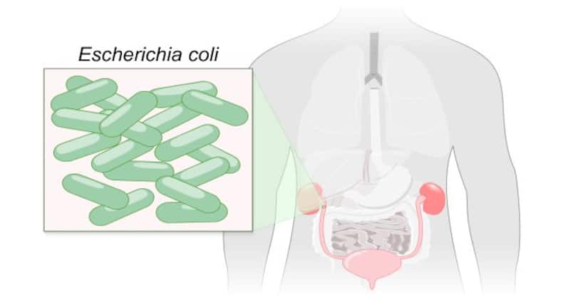 5 symptoms of UTI (urinary tract infection) in men