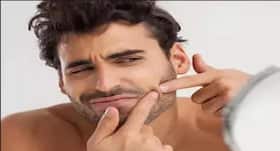 How to get rid of acne in summer?