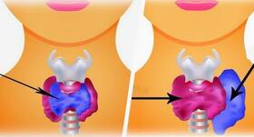 Hyperthyroidism और Hypothyroidism के बीच क्या अंतर है? Hyperthyroidism और Hypothyroidism के बीच क्या अंतर है?