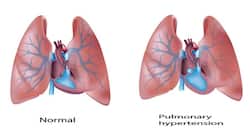 What is pulmonary hypertension?