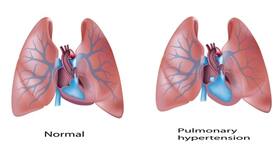 What is pulmonary hypertension?