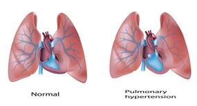What is pulmonary hypertension?