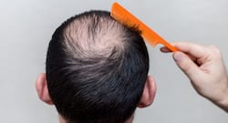 The most effective treatment options for balding