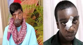 Shocking! Surgeons remove fist-sized brain matter from tribal boy's face
