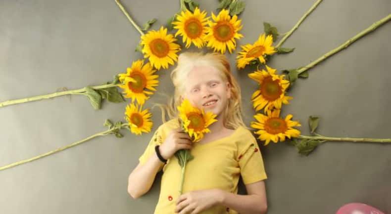International Albinism Awareness Day: 9 important facts about albinism