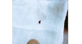 Image of blood clot removed from patient's coronary artery goes viral; has a life lesson that'll make you think