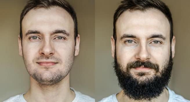 Image result for Beard hair transplant