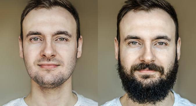 All you need to know about facial hair transplants or beard transplants |  