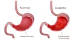 Gastritis