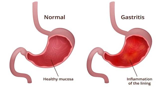 gastritis