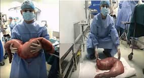 Chinese man constipated for 22 years has 13 kg of poop removed from his body