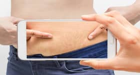 Nano-perforation -- Latest beauty treatment for stretch marks Nano-perforation -- Latest beauty treatment for stretch marks