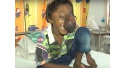 A 9-year-old boy from Assam, suffering from a rare condition called frontonasal encephalocele, and NO, he is NOT an incarnation of Lord Ganesha