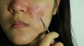 Are blackhead extractors safe to be used at home? Are blackhead extractors safe to be used at home?