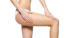 All you need to know about stretch marks