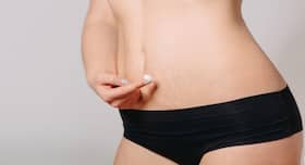 4 Effective Medical Treatments For Stretch Marks 4 Effective Medical Treatments For Stretch Marks