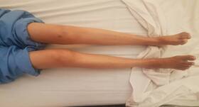 32-year-old woman from Uran successfully undergoes Bilateral Total Knee Replacement
