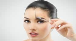 How to get rid of acne overnight?