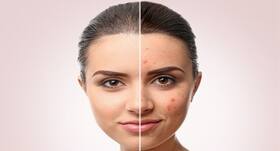 Acne - dos and dont's you must follow