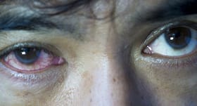आंखों में Viral infection के संकेत और रोकथाम के तरीके! आंखों में Viral infection के संकेत और रोकथाम के तरीके!