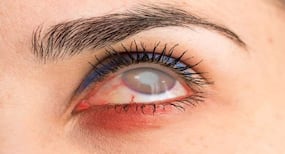 3D printed cornea: Bot's the Reality? 3D printed cornea: Bot's the Reality?