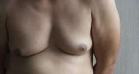Breast cancer क्यों पुरूषों को होता है? जानें इससे बचने के 6 एक्सपर्ट टिप्स!