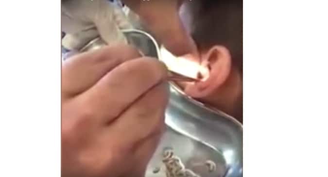 Doctors remove wriggling maggots from boy's ear (Watch video