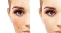 How to get rid of acne in a week?