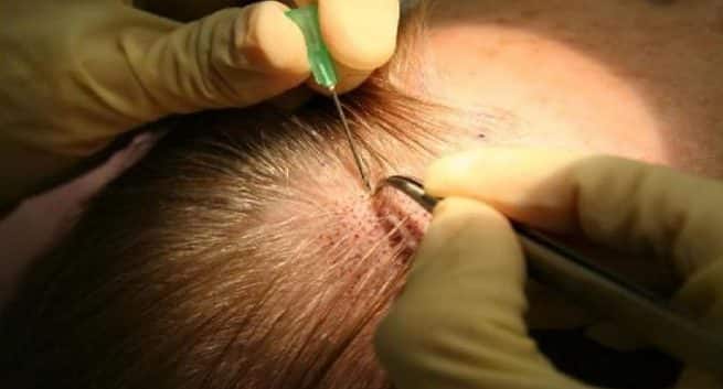 Image result for Opt for surgery for Receding Hairline