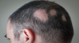 Scalp Tissue Expansion Treatment क्या है और इसे कौन करा सकता है?