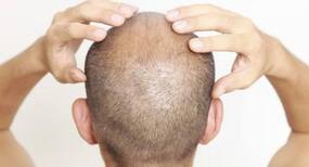 Does platelet-rich plasma help in treating hair loss?