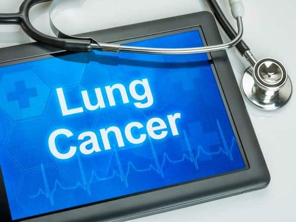lung cancer faqs: an expert answers why lung cancer is on the