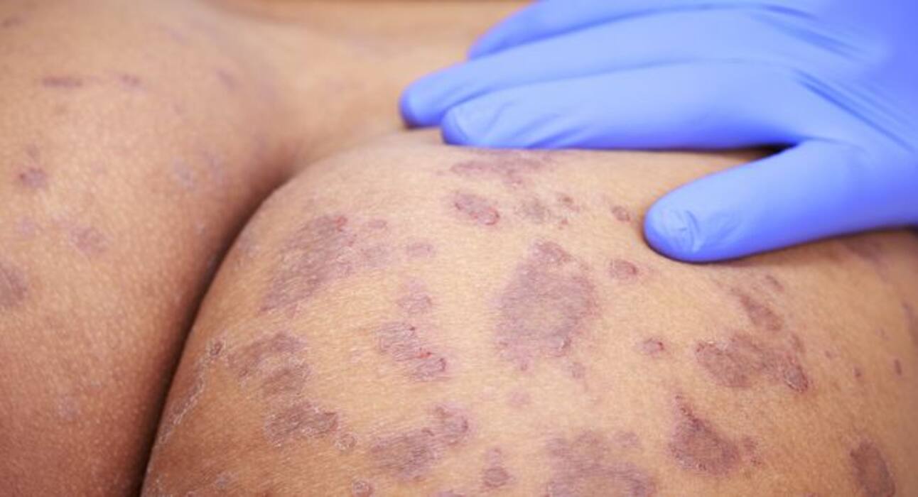 5 reasons your buttocks itch like crazy!