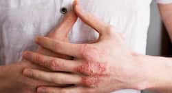 World Psoriasis Day 2021: Is COVID-19 More Dangerous For Psoriasis Patients?