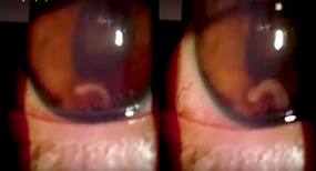 Mexico: Worm digs hole in 17-year-old boy's eye causing permanent vision loss (watch video)