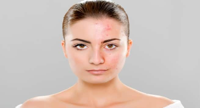 How to feel confident with acne? | TheHealthSite.com