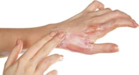 5 things to keep in mind when treating a burn at home