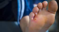 Diabetics कॉर्न और कॉलस होने पर एेसे करें पैरों की देखभाल!