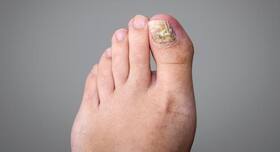 Here's what you should do if your nails fall off